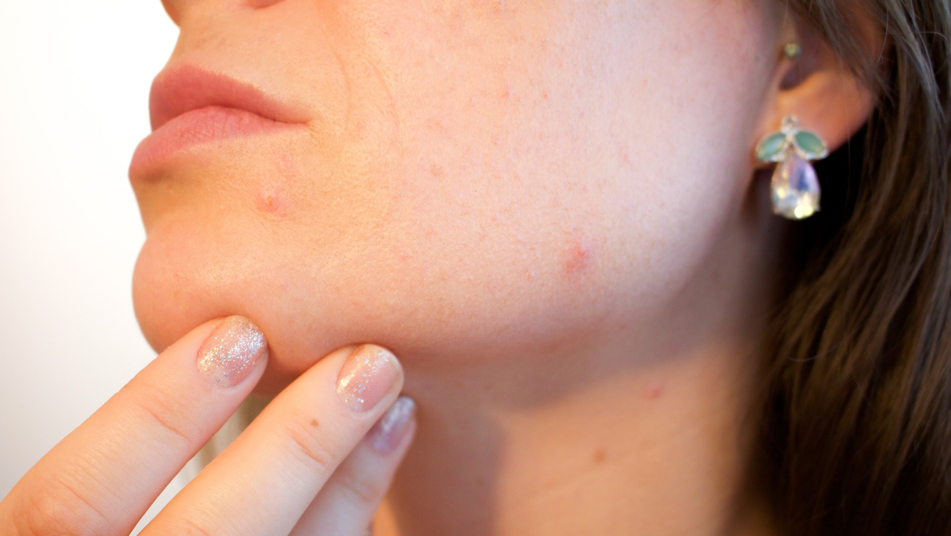 Woman with pimples