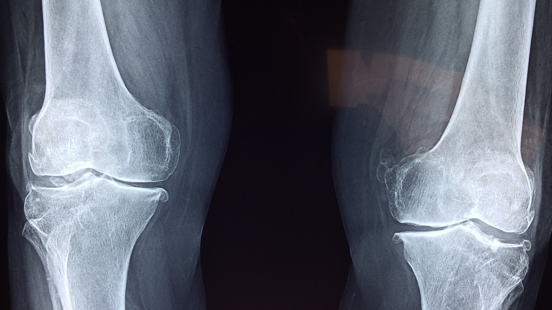 X-ray of knee